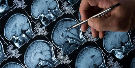 &iquest;Qu&eacute; pasa en el cerebro de una persona con alzh&eacute;imer? | Alzheimer y m&aacute;s (Bolet&iacute;n n&ordm; 91) | Scoop.it