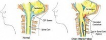 Chiari Malformation and Sudden Symptoms After Car Accident | Personal Injury Attorney News | Scoop.it