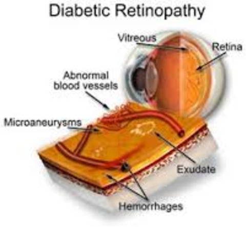 Comparing the Effectiveness of Telemedicine and Traditional Surveillance in Providing Diabetic Retinopathy Screening | Social Health on line | Scoop.it