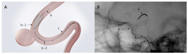 Efficacy and safety of a new mechanical balloon-based flow diverter in the treatment of intracranial aneurysms&nbsp; | Neurovascular Intervention | Scoop.it