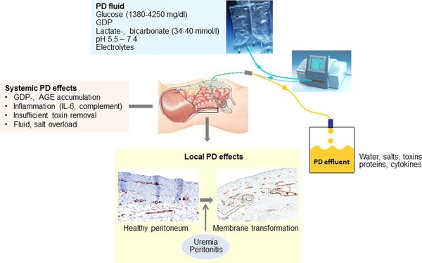 Biocompatible Peritoneal Dialysis: The Target Is Still Way Off | Peritoneal dialysis | Scoop.it