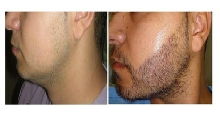 Сколько стоит пересадка бороды. Трансплантация волос на бороду. Борода после пересадки. Пересадил волосы на бороду.