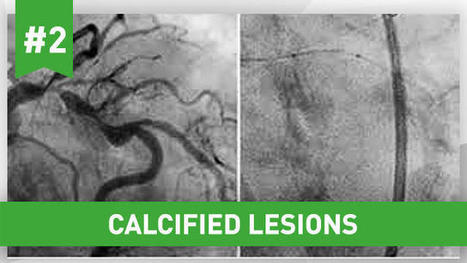 #2 How should I treat a large vessel with massive calcification? | CME-CPD | Scoop.it