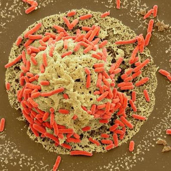 Explosion du #CancerColorectal chez les jeunes : une toxine bactérienne en cause ? #Prévention #Risque @mdiazgay @UCSanDiego #Dépistage @JohnsHopkins #AlimentationSaine | autour du CANCER | Scoop.it