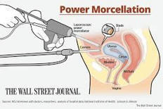 Laparoscopic Power Morcellation lawsuit | Cancer diagnosis | Providence Car Accident and Personal Injury Lawyer-Rhode Island | Scoop.it