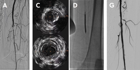 Navigating the 2026 Lower Extremity CPT Code Restructure | Critical Limb-Threatening Ischemia (CLTI) | Scoop.it