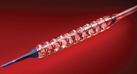 Chocolate Touch drug-coated angioplasty balloon for treatment of PAD receives FDA approval | Critical Limb-Threatening Ischemia (CLTI) | Scoop.it