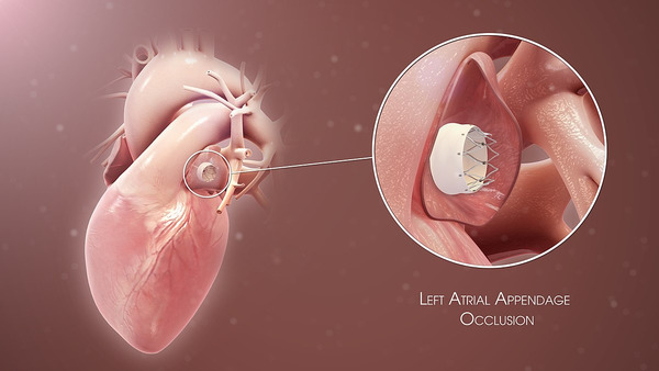 Challenges and advances in device-related thrombus in left atrial appendage occlusion | Transcatheter Treatment of Mitral Regurgitation | Scoop.it