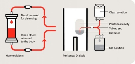 Types of Dialysis | Peritoneal dialysis | Scoop.it