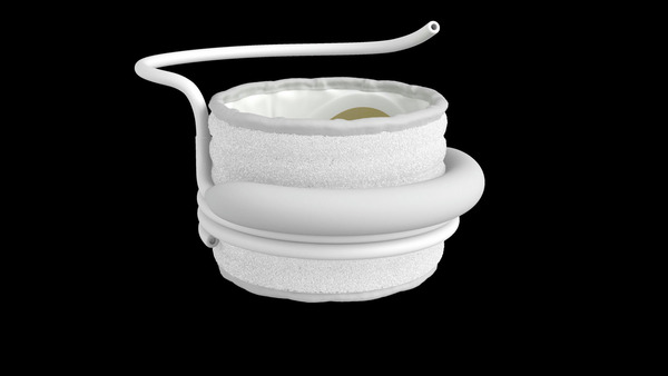 Edward Lifesciences’ Sapien M3 transfemoral mitral valve system gains CE mark | Transcatheter Treatment of Mitral Regurgitation | Scoop.it