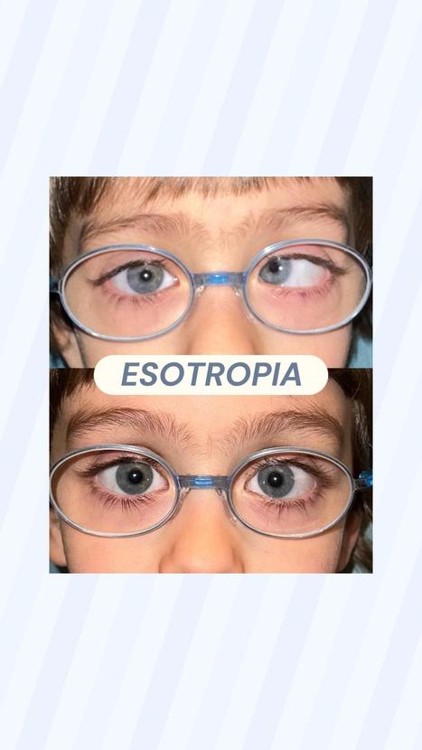 Trasformazione Visiva: Correzione dell'Esotropia in giovane paziente | Dr. Maria Elisa Scarale | The Eye News | Scoop.it