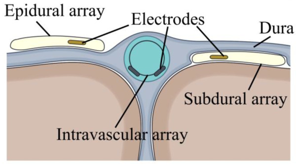 In Vivo Impedance Characterization of Cortical Recording Electrodes Shows Dependence on Electrode Location and Size | Brain Computer Interfaces & connected medical devices | Scoop.it