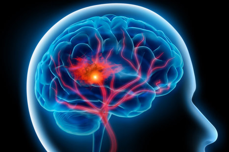 The stroke east Saxony pilot project for organized post-stroke care: a case–control study - Bodechtel - 2016 - Brain and Behavior - Wiley Online Library | Daily Newspaper | Scoop.it