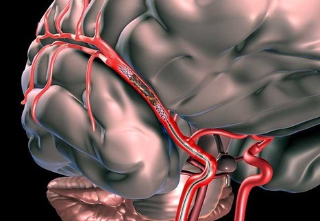 Thrombectomy fails to find a benefit in the older population with low ASPECTS | Neurovascular Intervention | Scoop.it