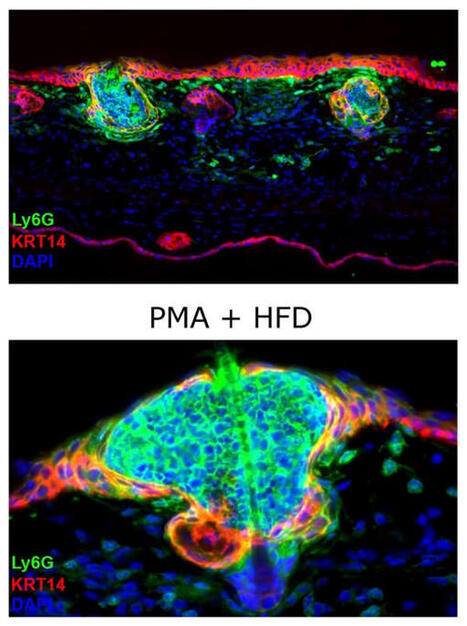 Profile of a pimple... - Journal of Clinical Investigation | Immunology | Scoop.it