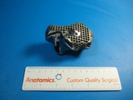 Seven life-changing surgeries made possible by 3D printing in 2014 | Amazing Science | Scoop.it