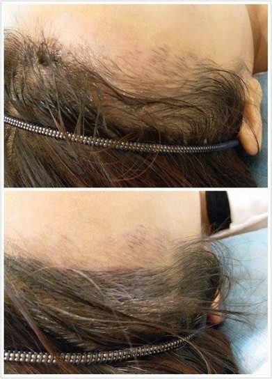 Hairline Embroidery Sg Microblading Hairline S