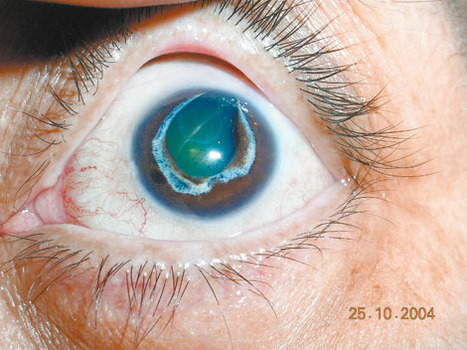 La UNAM investiga los genes relacionados con el glaucoma | Salud Visual (Profesional) 2.0 | Scoop.it