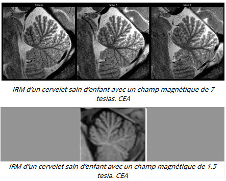 Cerveau de l’enfant : une nouvelle technique d’IRM permet d’obtenir des images d’une précision inédite | Life Sciences Université Paris-Saclay | Scoop.it