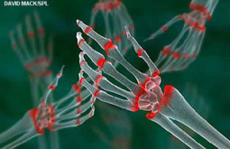 The BMJ Today: Treatments for inflammatory diseases | Rheumatology-Rhumatologie | Scoop.it