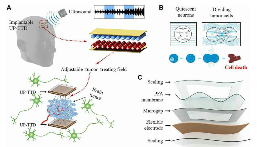 Ultrasound-powered Implant Treats Brain Cancer ...