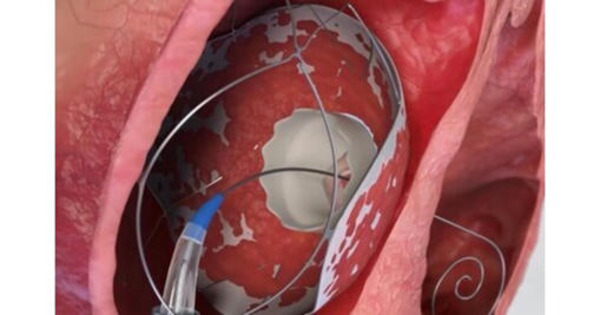 TruLeaf Medical, a fully-owned subsidiary of Allmed Solutions successfully Completed the Second Stage of valve implantation in two Additional Patients | Transcatheter Treatment of Mitral Regurgitation | Scoop.it