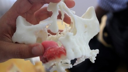3D printing helps build upper jaw prosthetic for cancer patient | Buzz e-sante | Scoop.it