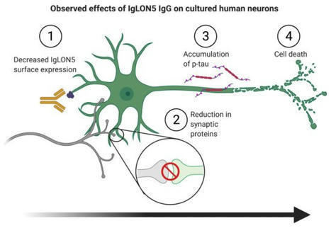 Cells | Free Full-Text | Neurodegeneration Induced by Anti-IgLON5 Antibodies Studied in Induced Pluripotent Stem Cell-Derived Human Neurons | AntiNMDA | Scoop.it
