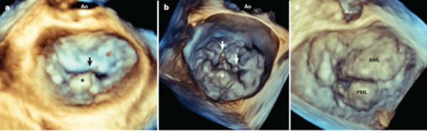 Degenerative mitral regurgitation | Transcatheter Treatment of Mitral Regurgitation | Scoop.it