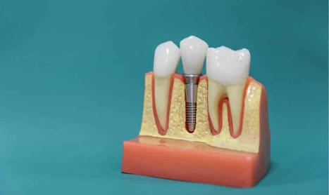 Enhance Your Oral Health With Dental Implants in Fort Worth | My Affordable Dentist Near Me | Scoop.it