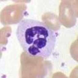 Fever Chemotherapy Infection Neutropenia blood test malpractice ... | Hematology | Scoop.it