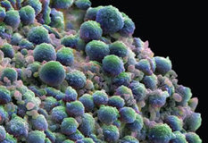 Immune Parameters correlate with Better Survival in Prostate Cancer patients treated with Sipuleucel-T | Immunopathology & Immunotherapy | Scoop.it