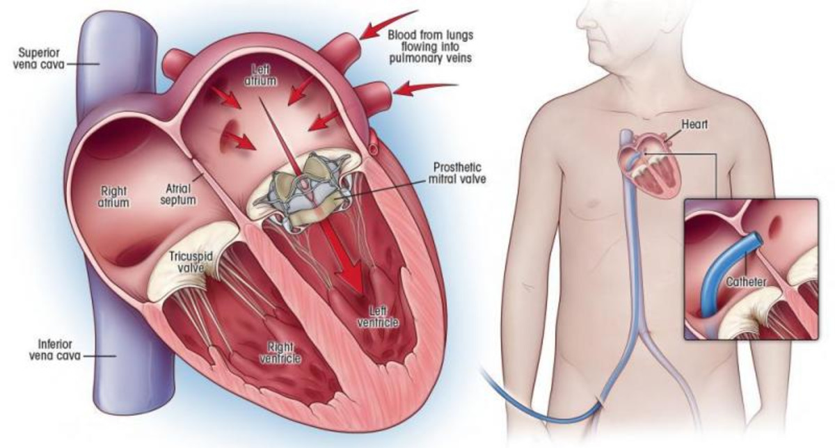Митральный клапан после операции. Сердце операция митральный клапан. Операция на митральном клапане. Транскатетерная имплантация митрального клапана. Протез митрального клапана.