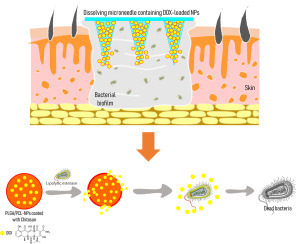 Bacterially sensitive nanoparticle-based dissolving microneedles of doxycycline for enhanced treatment of bacterial biofilm skin infection | Intra-Dermal drug delivery: Opportunities and Challenges? | Scoop.it