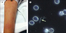 Maladie de Lyme : les chercheurs identifient une nouvelle bactérie | EntomoNews | Scoop.it