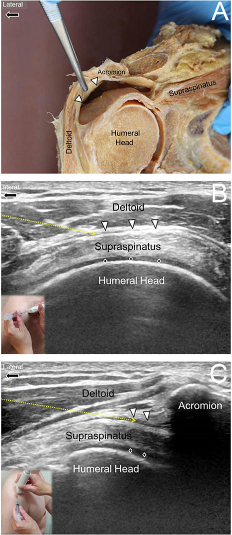 Ultrasound-guided interventions for painful shoulder: from anatomy to evidence | Rheumatology-Rhumatologie | Scoop.it