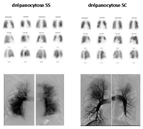 Développement d'une hypertension pulmonaire précapillaire chronique associée à la drépanocytose | Life Sciences Université Paris-Saclay | Scoop.it
