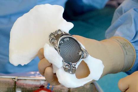 VIDEO. CHU Rennes. Ils posent une prothèse en titane sur mesure issue d’une imprimante 3D | Personnalisation de produit | Scoop.it