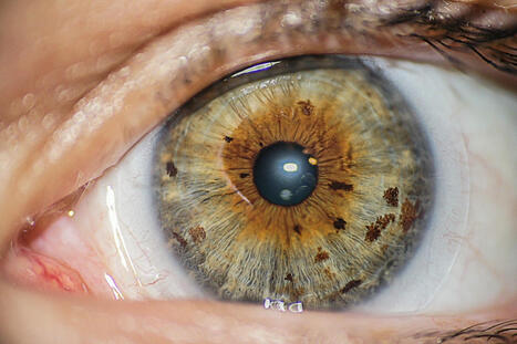 Doctors Say Injecting Gold Into Eyeballs Could Restore Lost Vision | The Health Report | Scoop.it