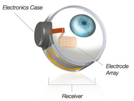 El primer ojo biónico acaba de ser implantado a un paciente | Salud Visual 2.0 | Scoop.it