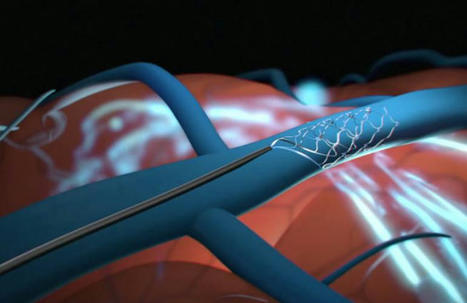 Synchron completes its endovascular brain implant technology rivaling Elon Musk's Neuralink | Amazing Science | Scoop.it