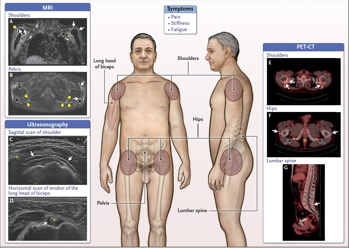 Polymyalgia Rheumatica | New England Journal of...