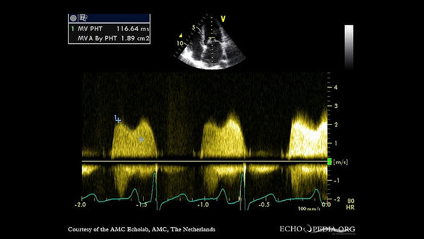 Lithotripsy for Mitral Valve Stenosis: What's the Promise? | Transcatheter Treatment of Mitral Regurgitation | Scoop.it