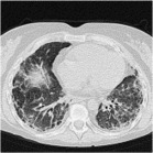 Lung involvement in connective tissue diseases: A comprehensive review and a focus on rheumatoid arthritis | Rheumatology-Rhumatologie | Scoop.it
