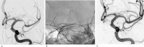 First-in-human trial of a self-expandable, temporary dilation system for intracranial atherosclerotic disease in patients presenting with acute ischemic stroke | Neurovascular Intervention | Scoop.it