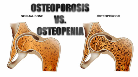 Osteoporosis vs. Osteopenia: What's The Difference? | El Paso, TX. | Spine Health & Spinal Hygiene | Scoop.it