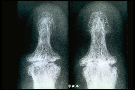 2023 EULAR classification criteria for hand osteoarthritis | RheumNow | Rheumatology-Rhumatologie | Scoop.it