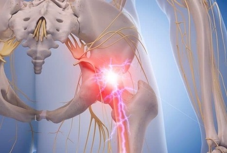 Piriformis Syndrome Management | El Paso, TX Chiropractor | Call: 915-850-0900  | Sports Injuries | Scoop.it