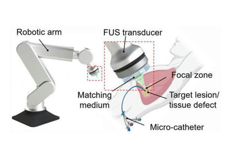 Une nouvelle méthode permet l'impression 3D directement à l'intérieur du corps humain  | Doctors Hub | Scoop.it