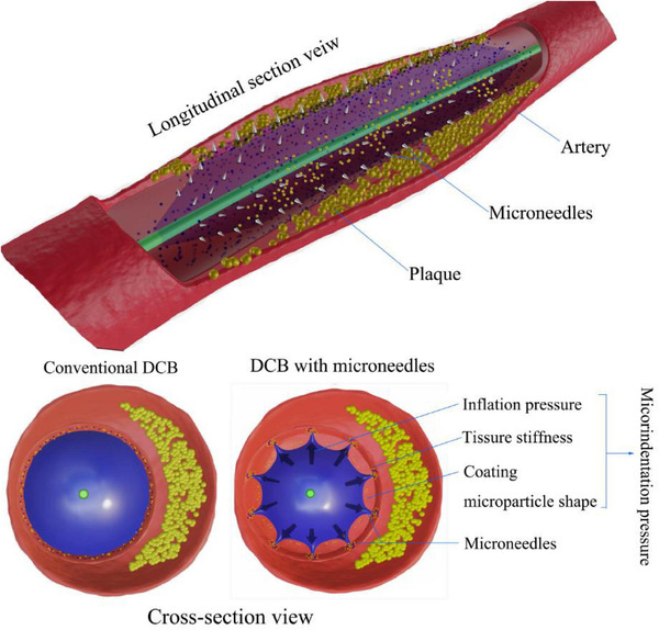 The factors influencing the efficiency of drug-coated balloons | Interventional Cardiology | Scoop.it